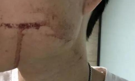 小伙拔牙10天后脑出血死亡