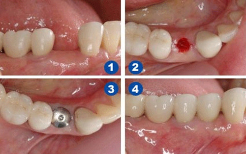 缺牙后，选择什么方式补牙比较好？