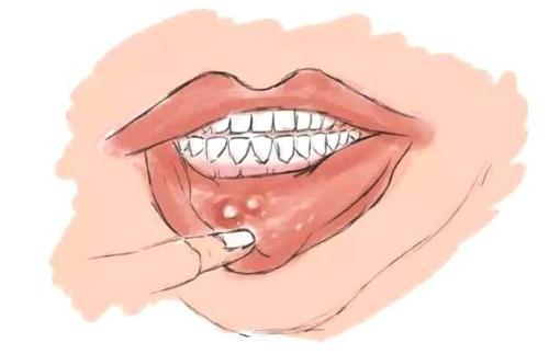“口腔溃疡”久治不愈，可能是风湿免疫病