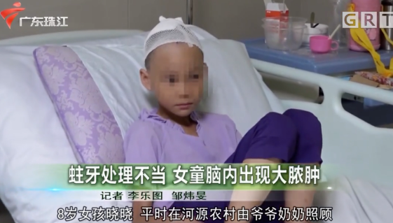 牙病处理不可轻视！8岁女童蛀牙致脑内长脓肿