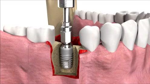 如何延长种植牙的使用寿命？