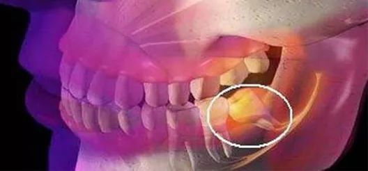 牙龈红肿、牙龈出血？要警惕这4种牙龈疾病！