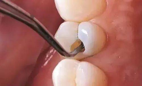 去补牙，怎么医生倒把牙洞越磨越大了？ 